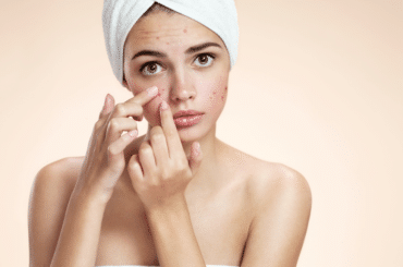 Mesoestetic Hautpflege bei Aknehaut